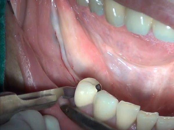 Apical repostioned flap